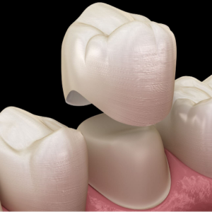 Corona Dental