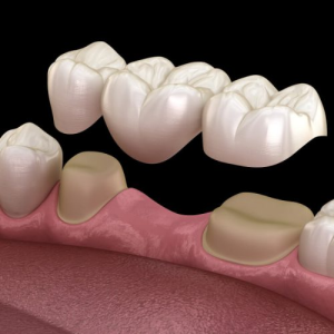 Puente Dental